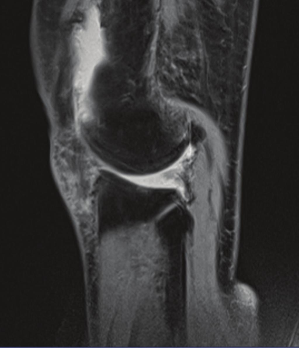 We reported two cases of the spontaneous recurrent hemarthrosis of the knee, in which a pulsating soft tissue with a tubular structure was identified on the exposed synovium in the posterolateral