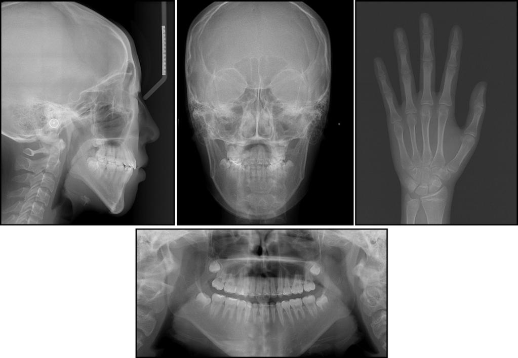 636 Chung et al Fig 13. Posttreatment cephalometric, panoramic, and hand-wrist radiographs. Fig 14.