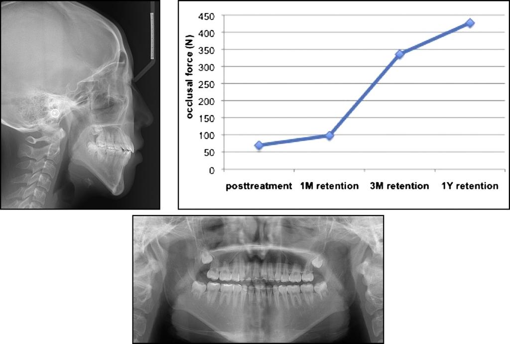 638 Chung et al Fig 17. One-year retention dental casts. Fig 18.