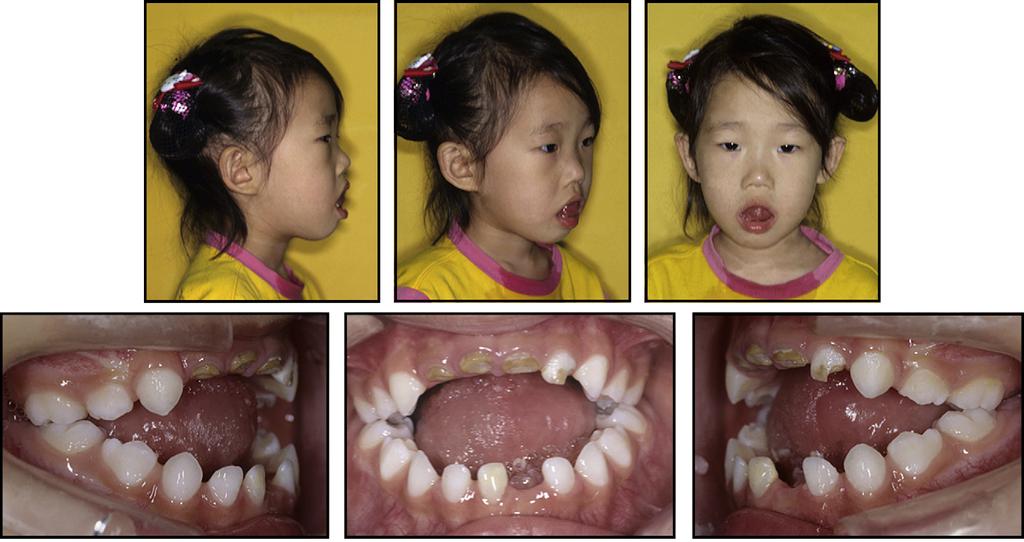 628 Chung et al Fig 1. Initial photographs, age 3 years 5 months. Fig 2. Initial dental casts, age 3 years 5 months. For these goals, reduction of excess tongue volume was of paramount importance.