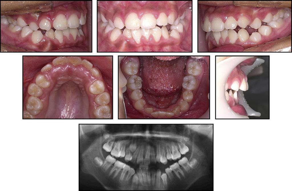 Chung et al 631 Fig 5. Intraoral photographs and panoramic radiograph at age 10 years 4 months. Canines on the right side are impacted. Fig 6.