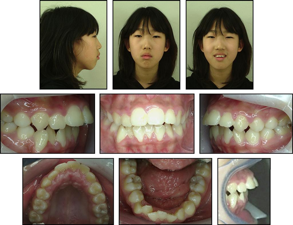 632 Chung et al Fig 7. Pretreatment photographs, age 12 years 1 month. The treatment plan for the second phase of orthodontic treatment was established.