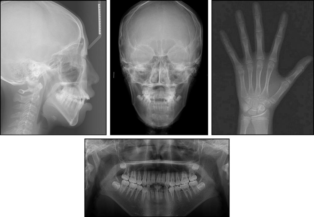 Chung et al 633 Fig 8. Pretreatment dental casts. Fig 9.