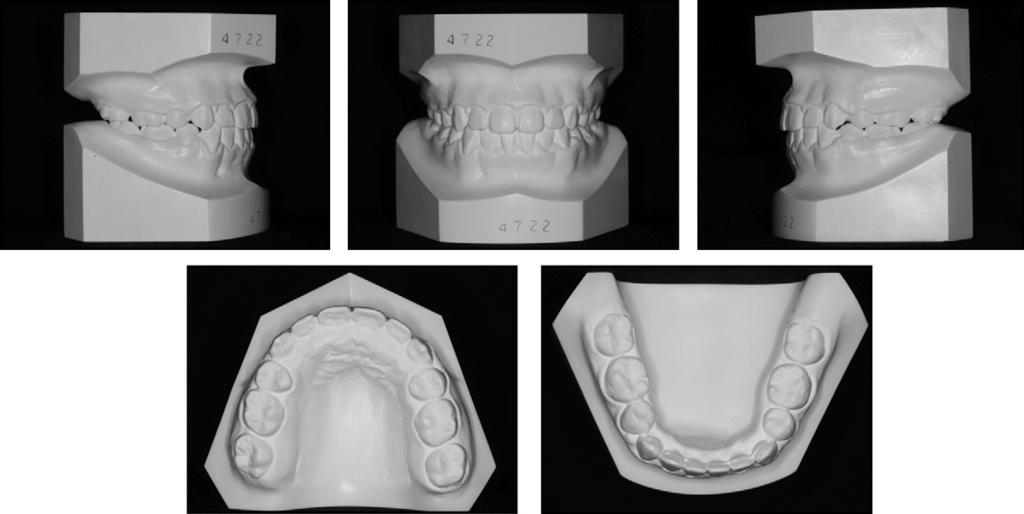 months. Fig 12. Posttreatment dental casts.