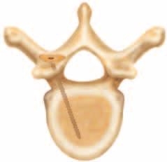 bone, if needed, to maximize the multi-axial capabilities