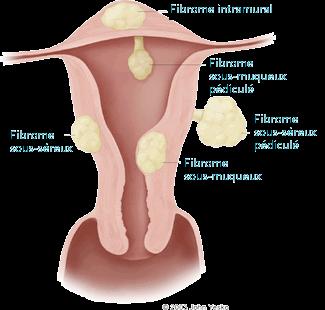 Myomas/endometriosis 8 Myomas - All contraception is possible depending of the localization and of the size