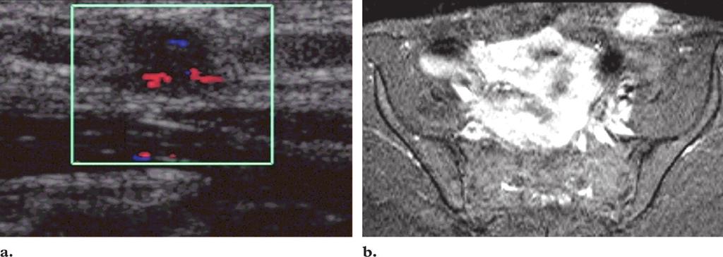 (b) Axial T1-weighted spin-echo MR image (repetition time msec/echo time msec 450/10) obtained with fat suppression and gadolinium shows enhancement of the mass.