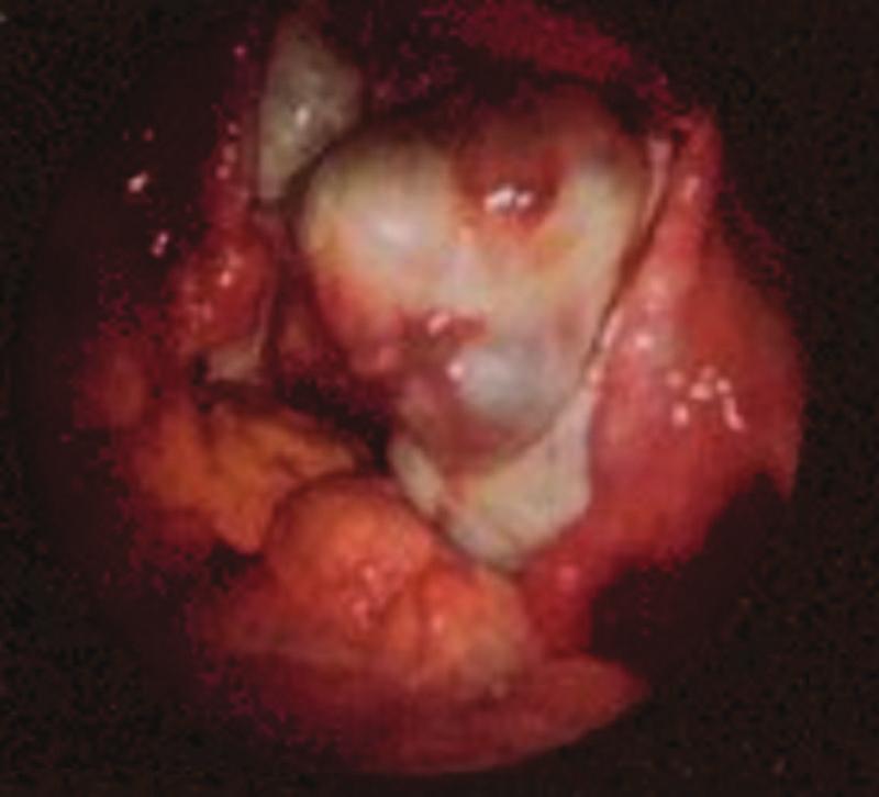 6 January-February 2005 RG f Volume 25 Number 1 Figure 4. Laparoscopic view demonstrates an endometrioma. Figure 5.