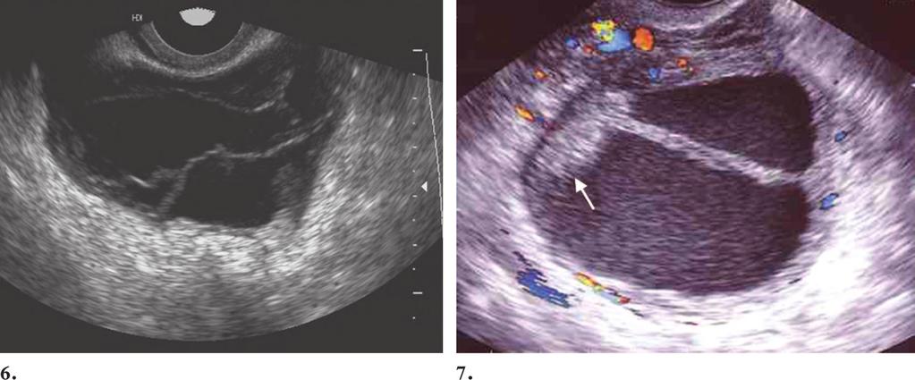 US is particularly helpful in the assessment of endometriotic cysts but has a limited role in the diagnosis of adhesions or peritoneal implants.
