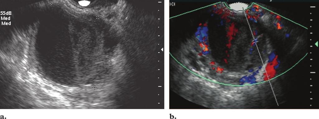 RG f Volume 25 Number 1 Kuligowska et al 7 Figure 8. (a) Transvaginal US image of a 37-year-old woman with cyclic pain shows a cystic mass with a fluid-debris level.