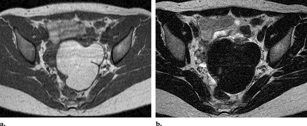 (a) Axial T1-weighted spin-echo image (450/10) reveals high-signal-intensity cystic masses within the fallopian tubes.