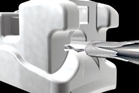 QuicKlear III brackets can be opened from the gingival or from vestibular direction.