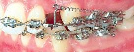retraction and torquing of anterior teeth.
