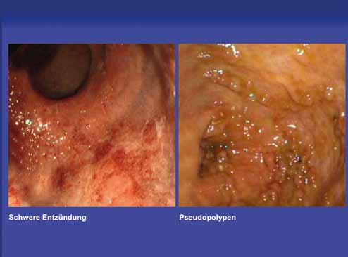 Severe inflammation Pseudopolyps Fig.