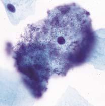 Potential biological pitfalls of HPV testing Endogenous flora (coccobacilli including Gardnerella sp.