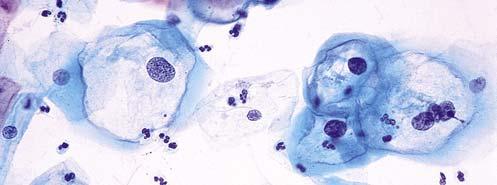 HPV related disease Anogenital tract skin and mucosa penile, vulvar, vaginal, cervical, and anal Oropharynx tonsils and base of tongue Skin most commonly low risk types, causing warts Papillomas of