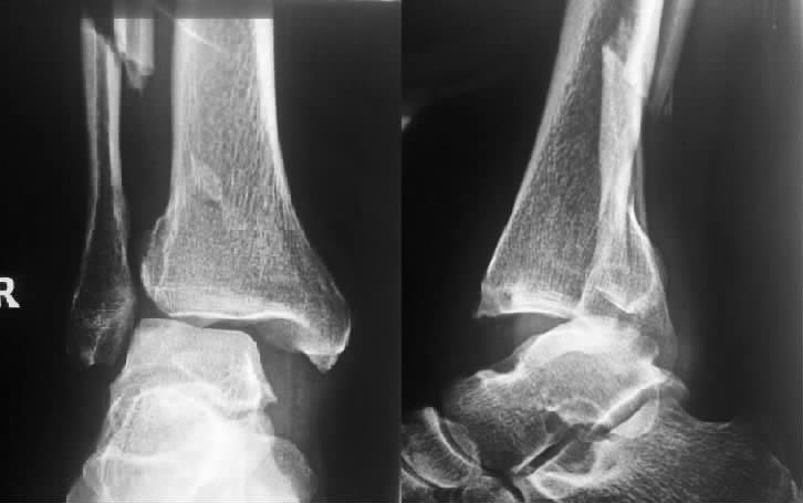 . 27 27 1 Figure 1 Flowchart of intervention A B 2 ( 31 ) X Figure 2 Images of a 31-year-old male patient with ankle fracture and deltoid ligament injury before and after suture anchor repair A X 9