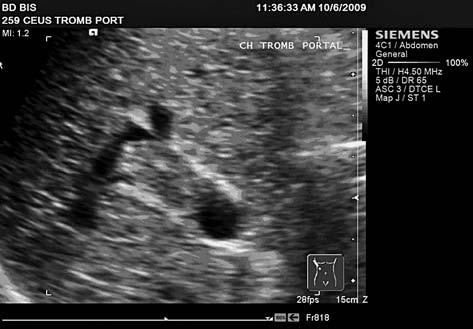 104 Mirela Dănilă et al The value of Contrast Enhanced Ultrasound in the evaluation of the nature of portal vein thrombosis The etiology of liver cirrhosis was C chronic hepatitis in 14 cases (48.
