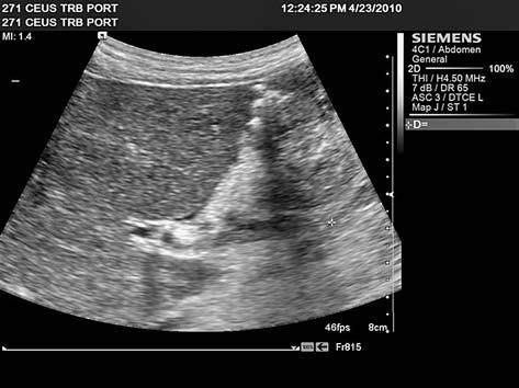 On standard ultrasound, the main PV trunk seemed to be hypoechoic with parenchymal content (fig 7) and we did not see a typical aspect of portal cavernoma.