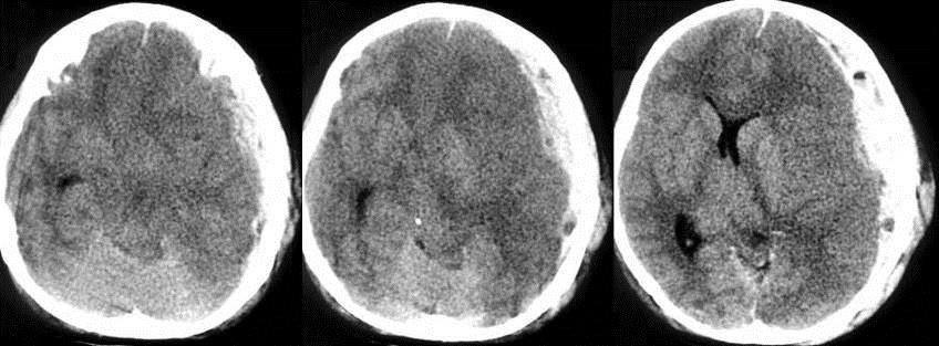 Subfalcine herniation (cingulate herniation) Transtentorial herniation The suprasellar cistern (left image) is obliterated.