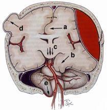 示意图 a) subfalcial (cingulate) herniation ; 镰下疝 b) uncal herniation ; 钩疝 c) downward (central, transtentorial) herniation ; 下行性小脑幕疝 d) external