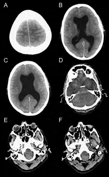 a male patient in his 30's who died of brain stem herniation after completing a marathon.