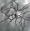 Normal number of dendritic spines on neurons postsynaptic to the