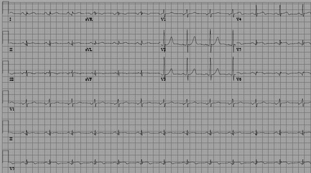 Case III Male, 56 yrs Medical history: s/p inferior MI (s/p PCI to RCA), Smoker 3-days