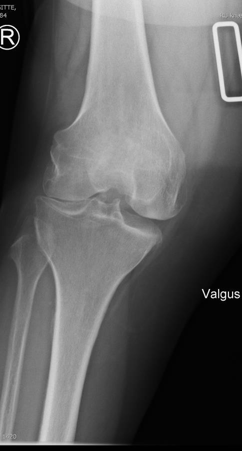 Supplemental imaging assessment medial comp. Case: Female, 58 Y, Right knee. Varus stress: Bone-on-bone medial comp.