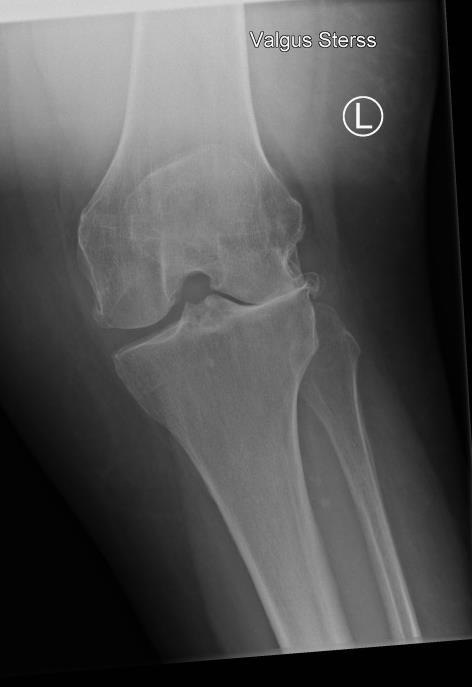 Case: Female, 73 Y, Left knee.