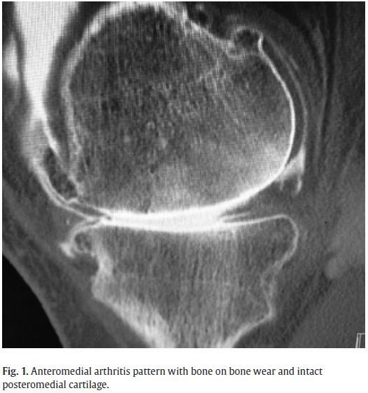 Supplemental imaging - CT arthrography CT