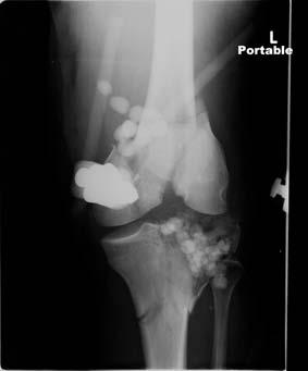 A B FIGURE 1 Anteroposterior (A) andlateral(b) radiographs demonstrating a comminuted, intra-articular, distal femur and bicondylar tibial plateau fractures with antibiotic beads secondary to a