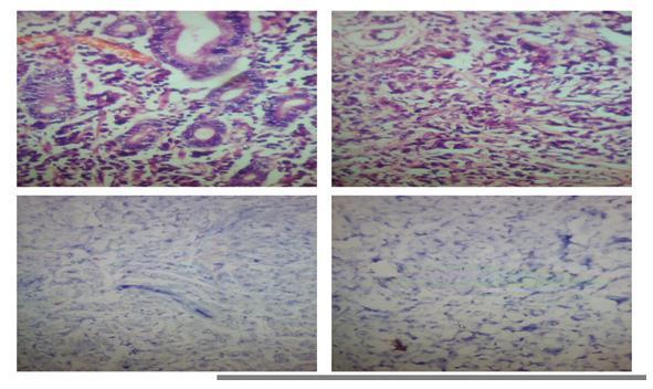 Similar cells infiltrating benign breast ductal cells (upper