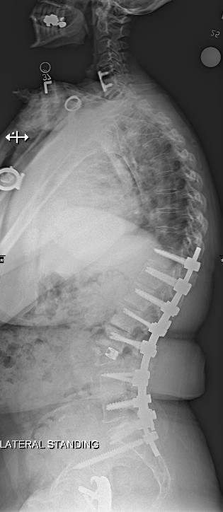 Study Objective & Methods Objective Investigate radiographic outcome and complications after