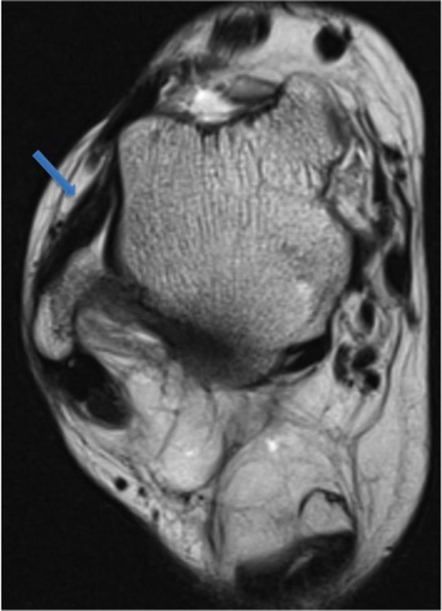 Images for this section: Fig. 1: 45-year-old woman with history of ankle ligament instability and anterolateral impingement.
