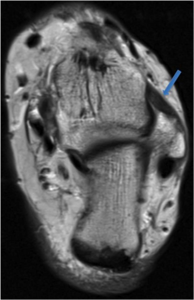 Fig. 2: 34-year-old woman with anterolateral impingement.