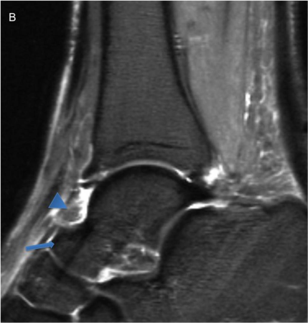Fig. 4: 38-year-old woman with anterior bone and soft-tissue impingement.
