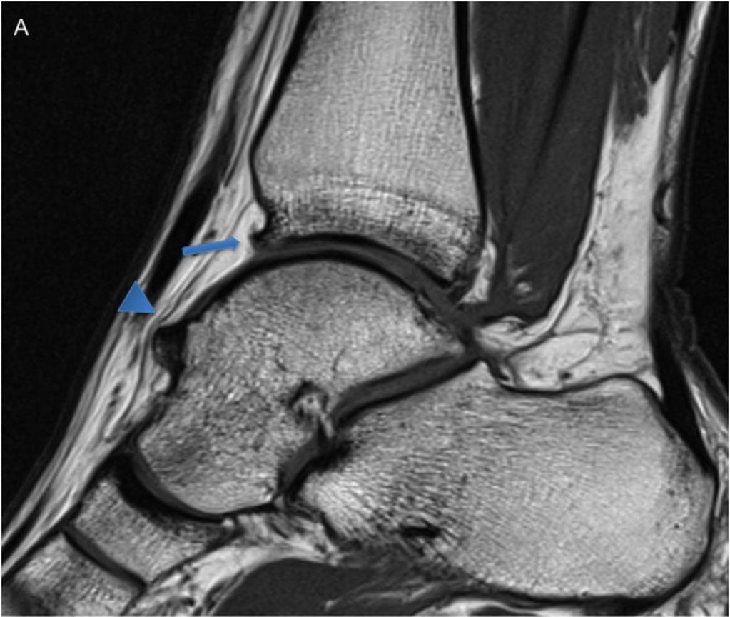 Fig. 5: 25-year-old man with anterior bone and soft-tissue impingement.