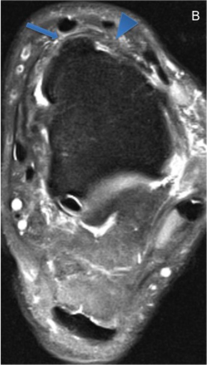 Fig. 6: 25-year-old man with anterior bone and soft-tissue impingement.