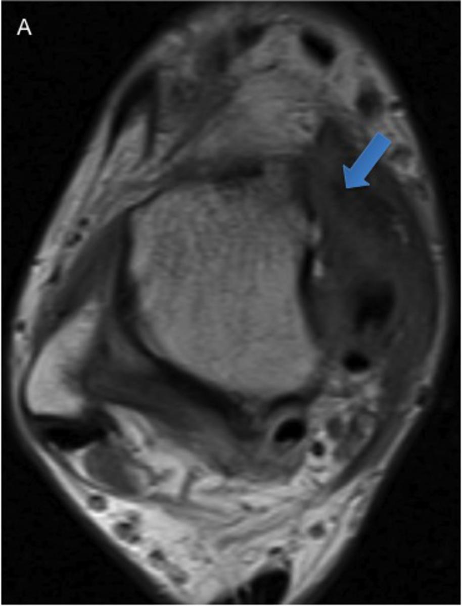 Fig. 7: 43-year-old man with anteromedial and posteromedial impingement.