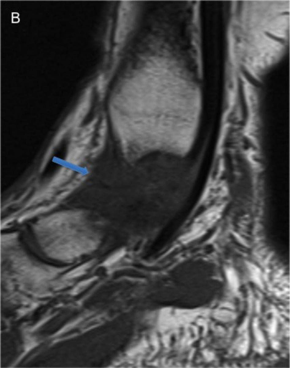 Fig. 8: 43-year-old man with anteromedial and posteromedial impingement.