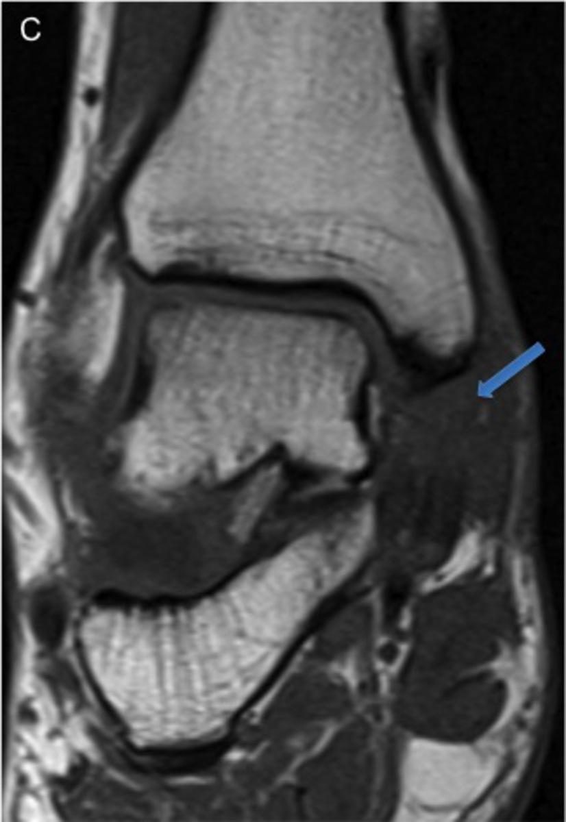 Fig. 9: 43-year-old man with anteromedial and posteromedial impingement.