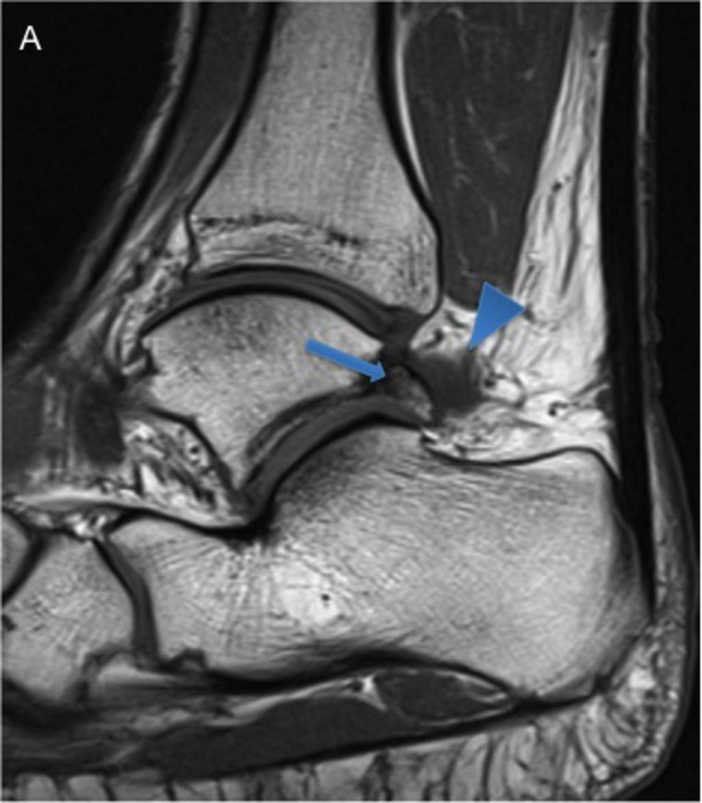 Fig. 11: 30-year-old man with posterior impingement.