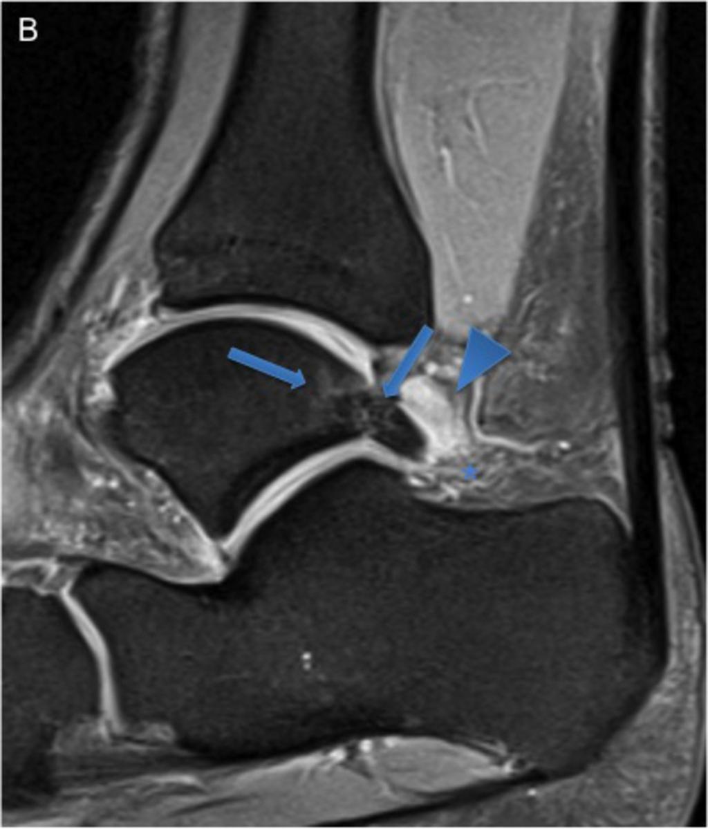 Fig. 12: 30-year-old man with posterior impingement.