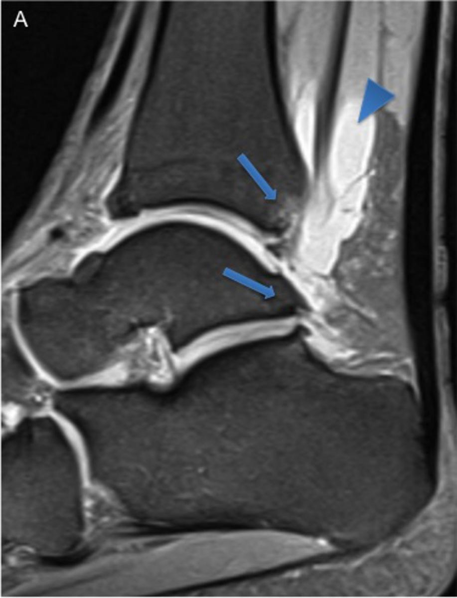 Fig. 13: 37-year-old man with posterior impingement.