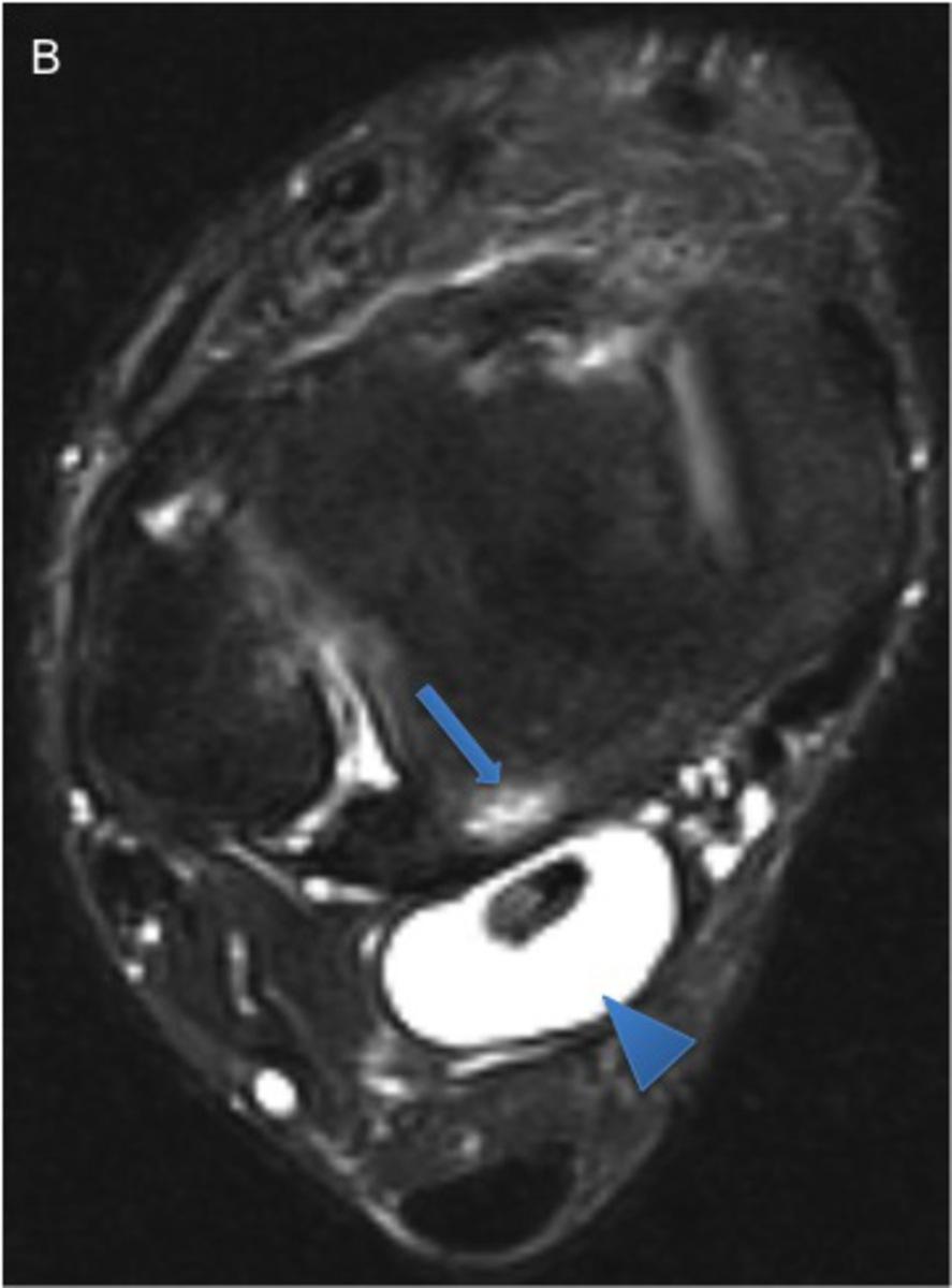 Fig. 14: 37-year-old man with posterior impingement.