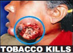 The 85% pictorial warnings on all cigarettes, bidis and chewing tobacco packages in India have resulted in