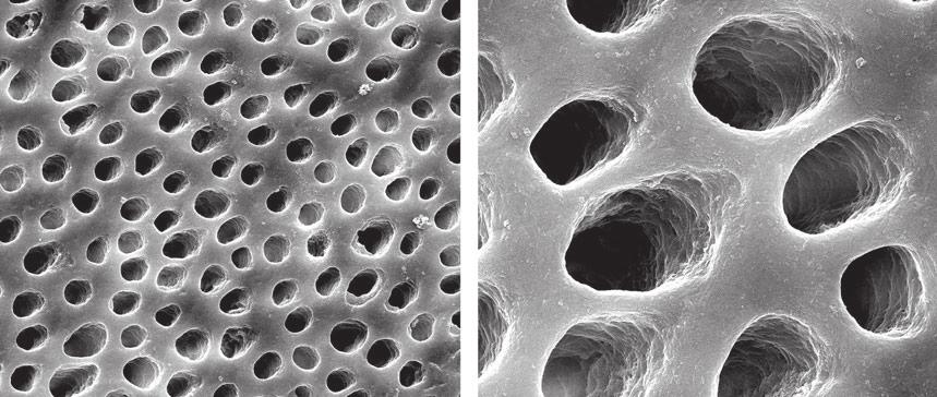 Y Zhong et al. (a) (b) Fig. 3 SEM images showing patent tubules on the dentine surfaces after erosion with 6% citric acid at 50009 (a) and 20 0009 (b) magnifications. (Figs. 4Q and 4R).