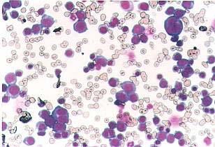 p/e he looked ill and pale, with Temp 40, BP 100/70, p 104, he had generalized LN enlargement, badly infected
