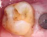 Condition dentin w PCA Acid etch enamel Preparation w cervical